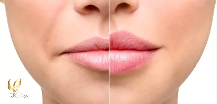 قبل و بعد از تزریق ژل لب در سن مناسب